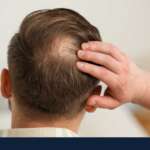 Causes de la perte de cheveux chez l&rsquo;homme