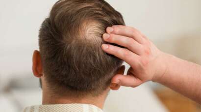Perte de cheveux homme