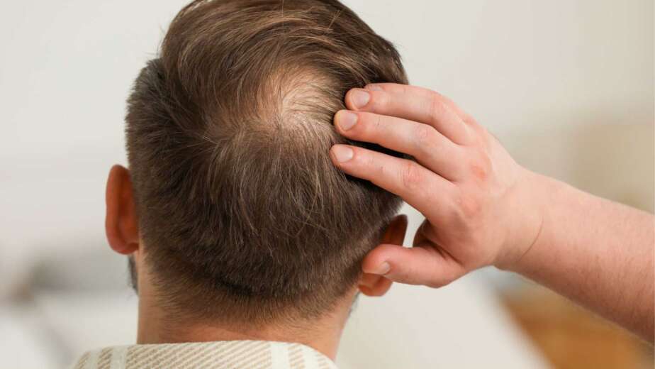 Perte de cheveux homme