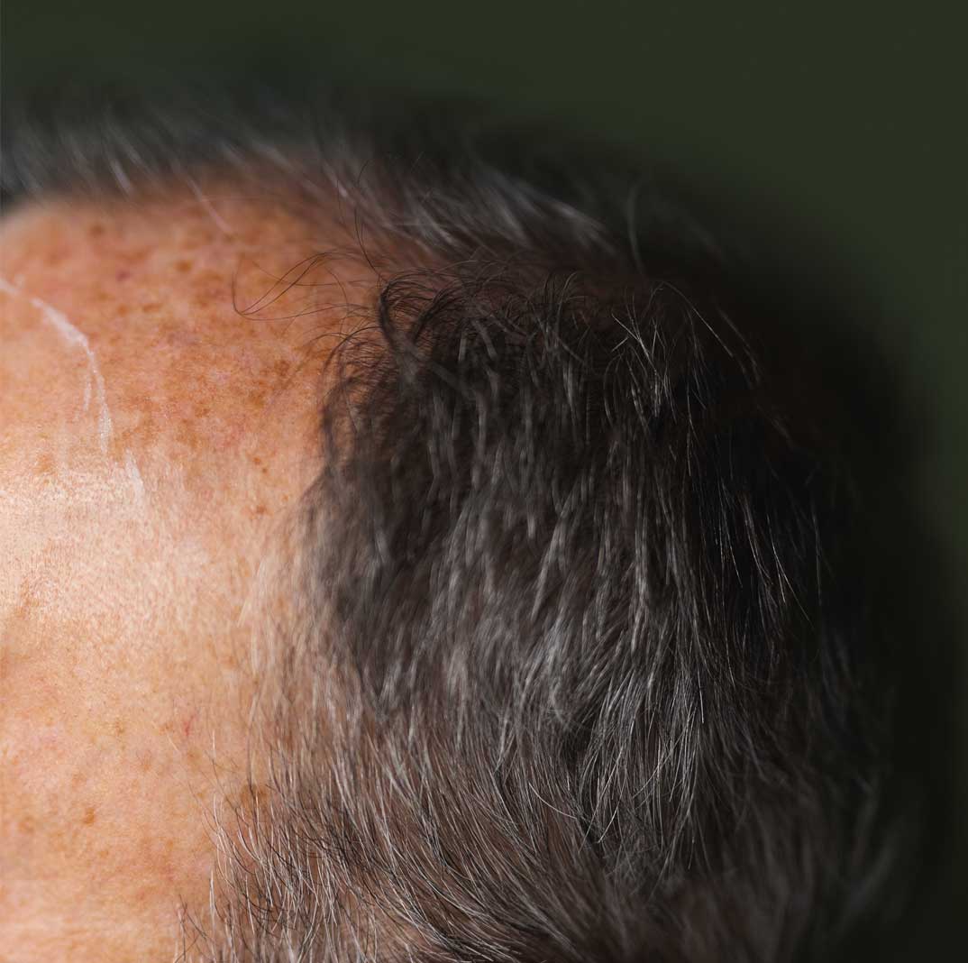 Traitement perte de cheveux Québec